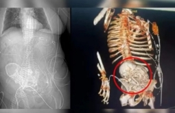 Idosa descobre feto calcificado que carregou por mais de 5 décadas